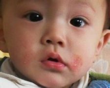什么是婴儿湿疹？