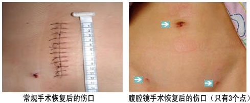 3,腹腔镜阑尾切除术腹壁切口疤痕更小,无需拆线,更符合美容的需要