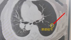 肺结节如何检查